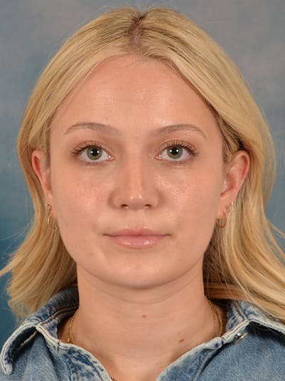 Rhinoplasty Before & After Gallery - Patient 365273 - Image 6