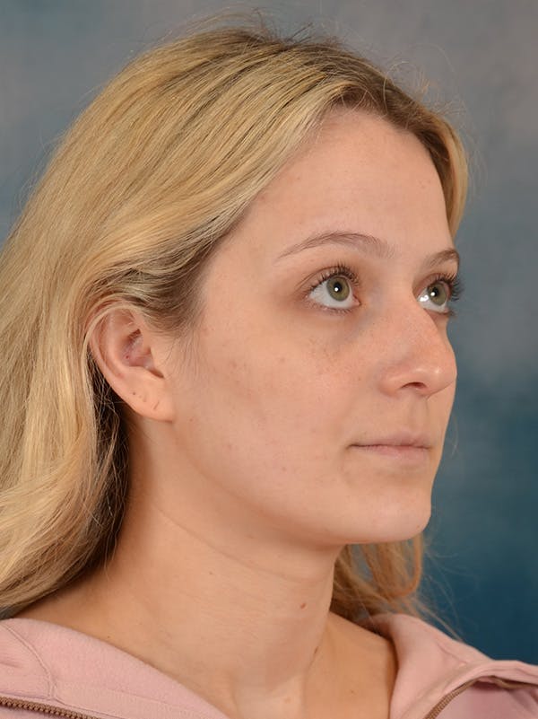 Rhinoplasty Before & After Gallery - Patient 365273 - Image 7