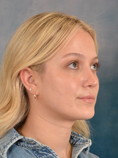 Rhinoplasty Before & After Gallery - Patient 365273 - Image 8