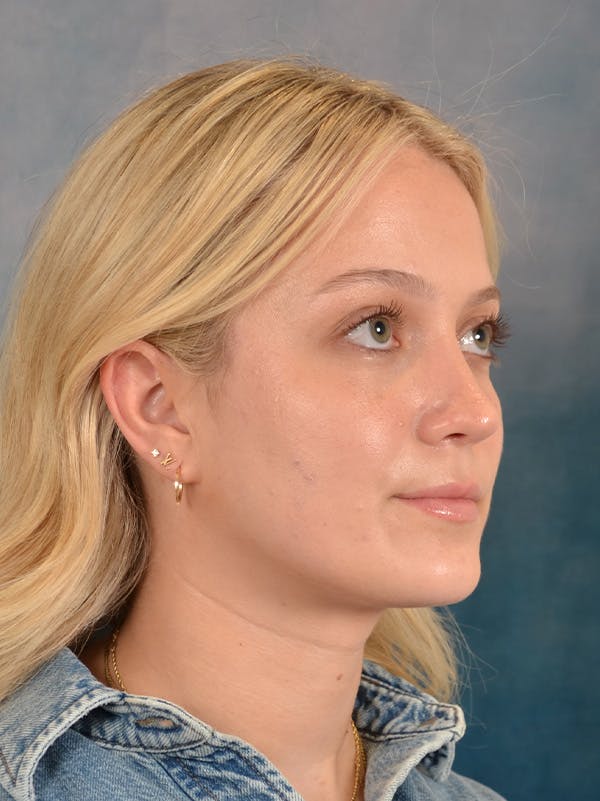Rhinoplasty Before & After Gallery - Patient 365273 - Image 8