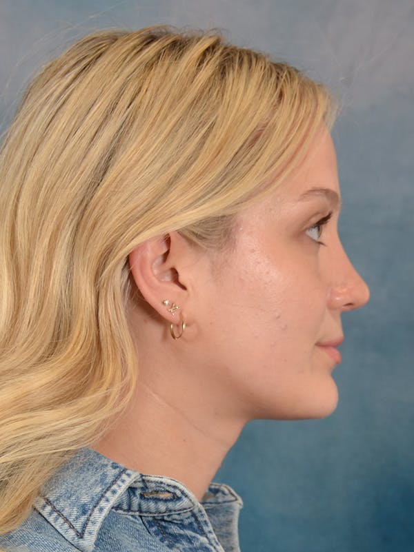 Rhinoplasty Before & After Gallery - Patient 365273 - Image 10