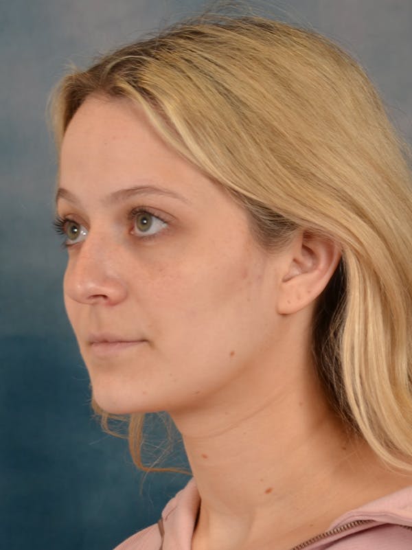 Rhinoplasty Before & After Gallery - Patient 365273 - Image 3