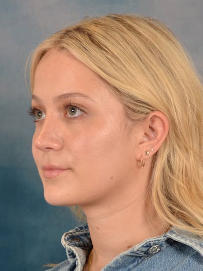 Rhinoplasty Before & After Gallery - Patient 365273 - Image 4