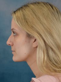 Rhinoplasty Before & After Gallery - Patient 544468 - Image 1