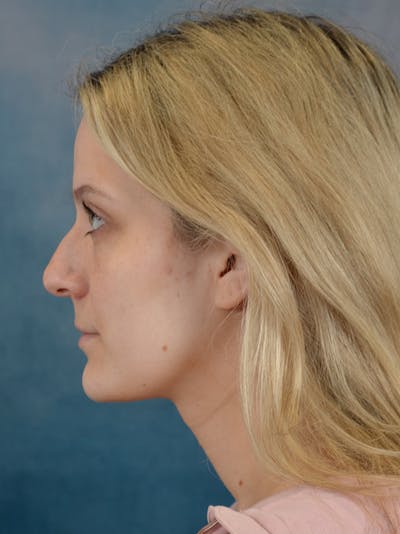 Rhinoplasty Before & After Gallery - Patient 365273 - Image 1