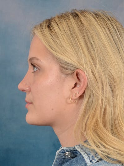 Rhinoplasty Before & After Gallery - Patient 365273 - Image 2