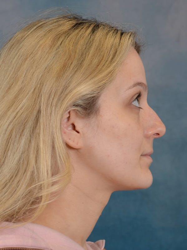 Rhinoplasty Before & After Gallery - Patient 365273 - Image 9