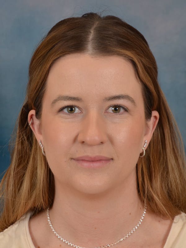 Rhinoplasty Before & After Gallery - Patient 147830 - Image 5