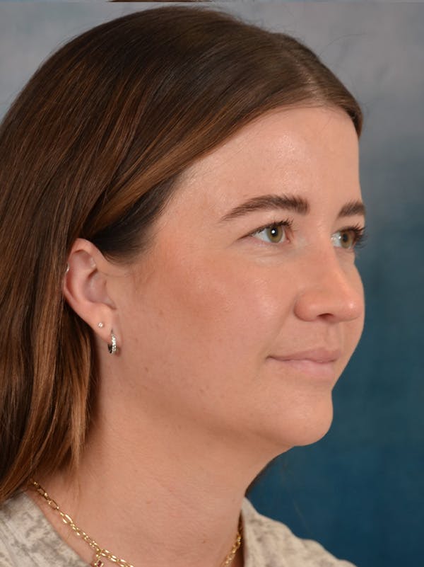Rhinoplasty Before & After Gallery - Patient 147830 - Image 8