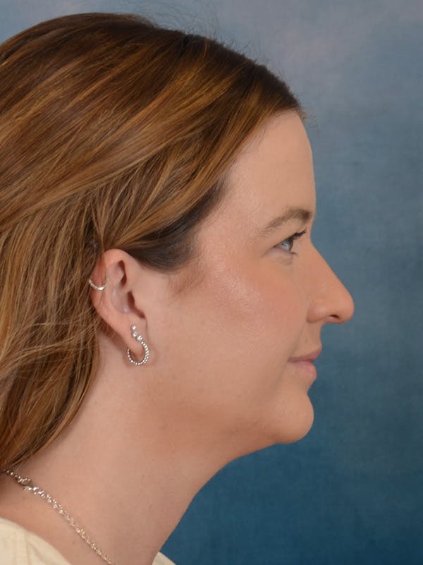 Rhinoplasty Before & After Gallery - Patient 147830 - Image 9