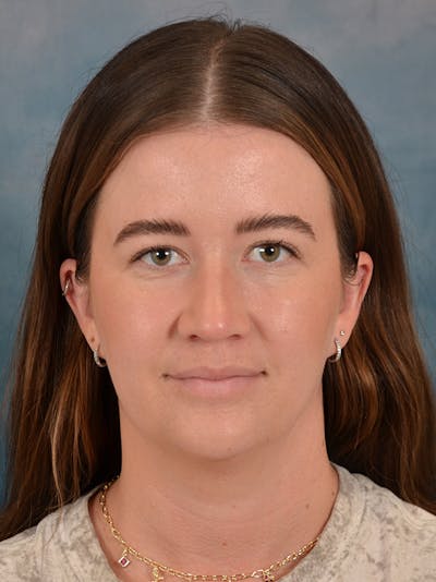 Rhinoplasty Before & After Gallery - Patient 147830 - Image 6