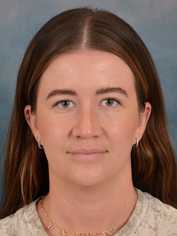 Rhinoplasty Before & After Gallery - Patient 147830 - Image 6