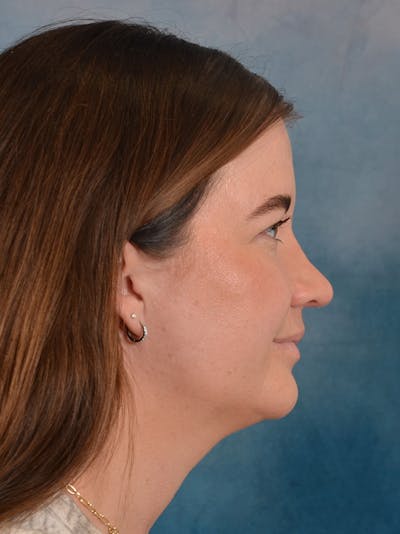 Rhinoplasty Before & After Gallery - Patient 147830 - Image 10