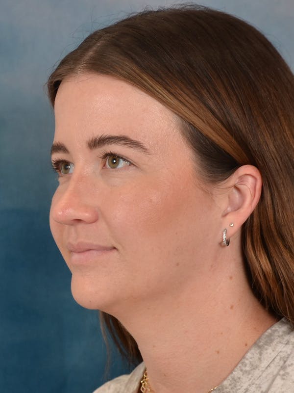 Rhinoplasty Before & After Gallery - Patient 147830 - Image 4