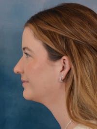 Rhinoplasty Before & After Gallery - Patient 544468 - Image 1