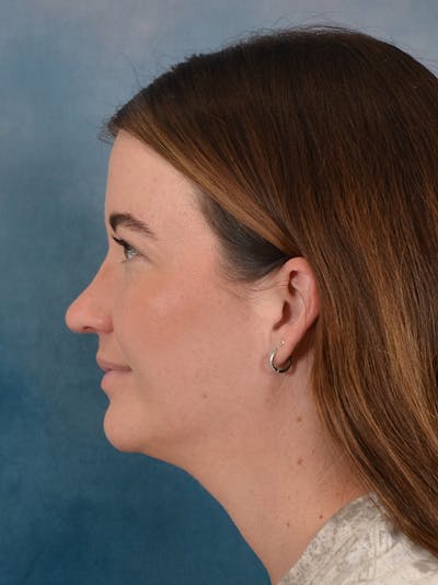 Rhinoplasty Before & After Gallery - Patient 147830 - Image 2