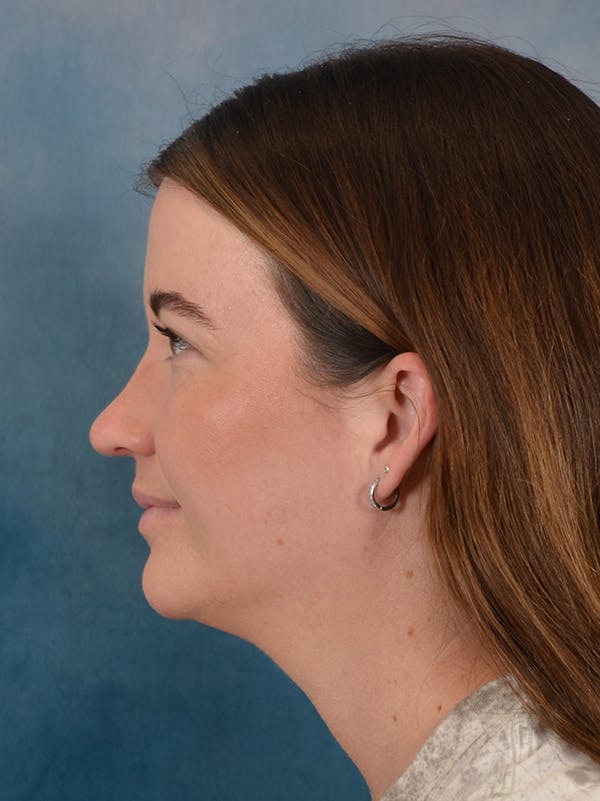Rhinoplasty Before & After Gallery - Patient 147830 - Image 2