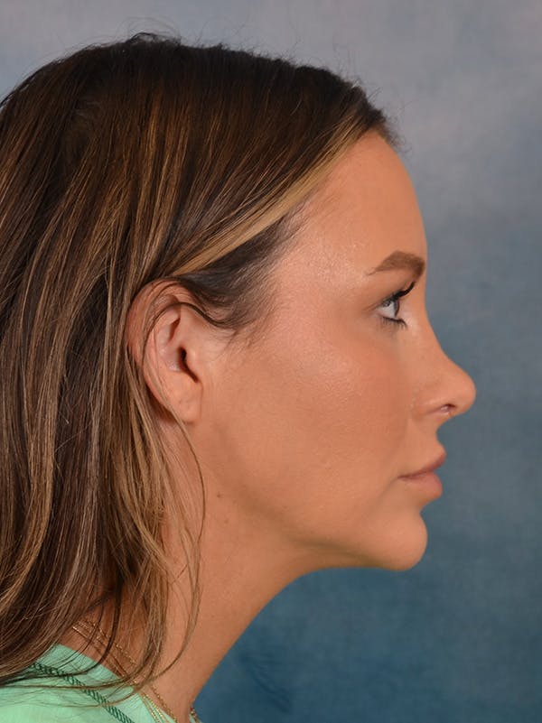 Rhinoplasty Before & After Gallery - Patient 191742 - Image 10