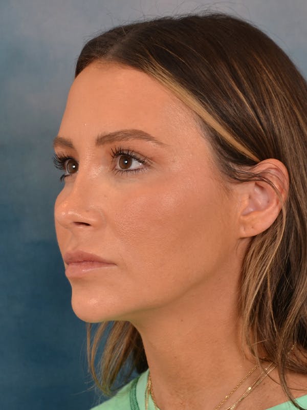 Rhinoplasty Before & After Gallery - Patient 191742 - Image 4