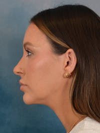 Rhinoplasty Before & After Gallery - Patient 544468 - Image 1