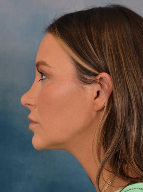 Rhinoplasty Before & After Gallery - Patient 191742 - Image 2