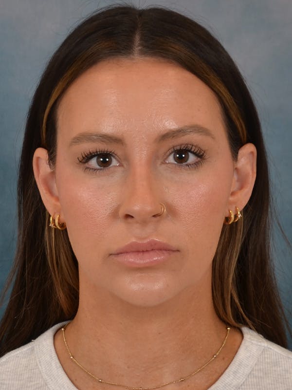 Rhinoplasty Before & After Gallery - Patient 191742 - Image 5
