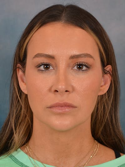 Rhinoplasty Before & After Gallery - Patient 191742 - Image 6