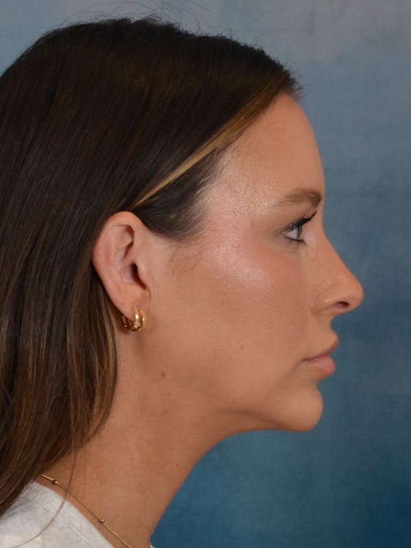 Rhinoplasty Before & After Gallery - Patient 191742 - Image 9