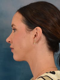 Rhinoplasty Before & After Gallery - Patient 544468 - Image 1