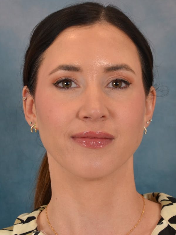 Rhinoplasty Before & After Gallery - Patient 544468 - Image 5