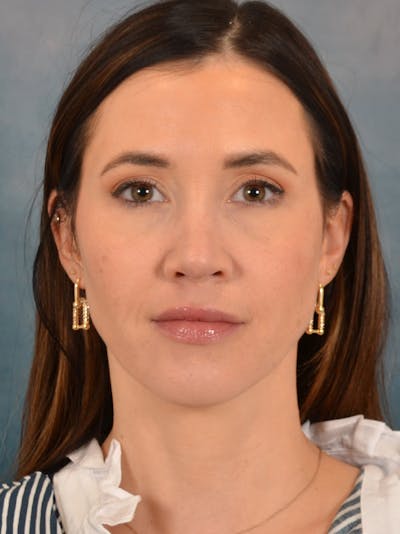 Rhinoplasty Before & After Gallery - Patient 544468 - Image 6