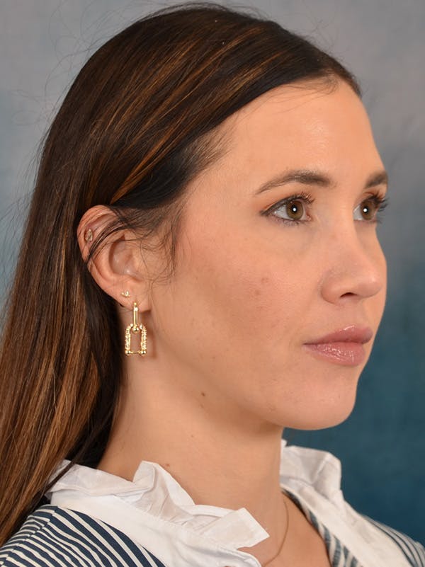 Rhinoplasty Before & After Gallery - Patient 544468 - Image 8