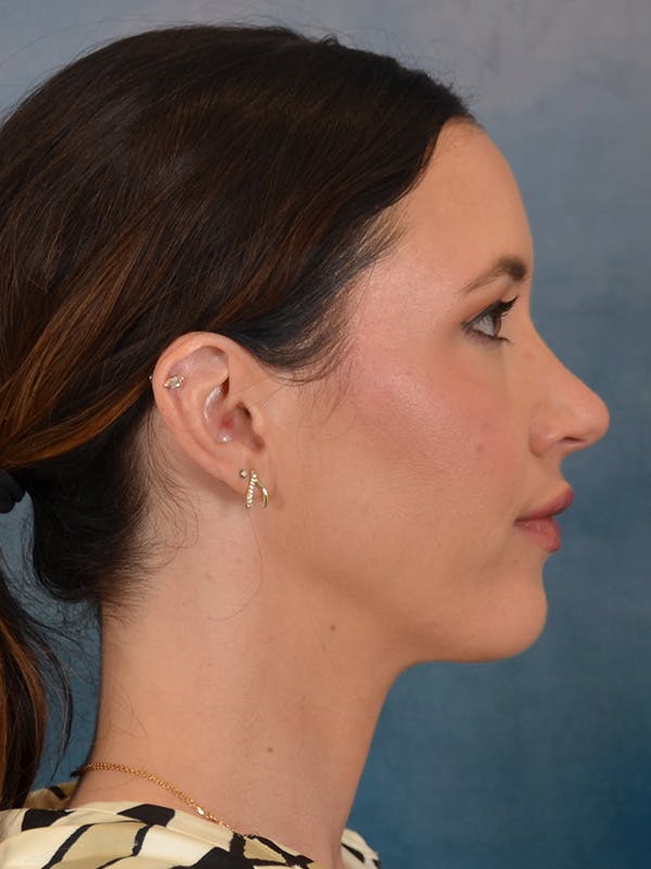 Rhinoplasty Before & After Gallery - Patient 544468 - Image 9