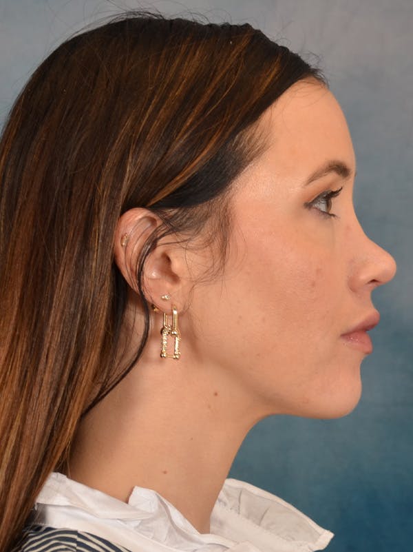Rhinoplasty Before & After Gallery - Patient 544468 - Image 10