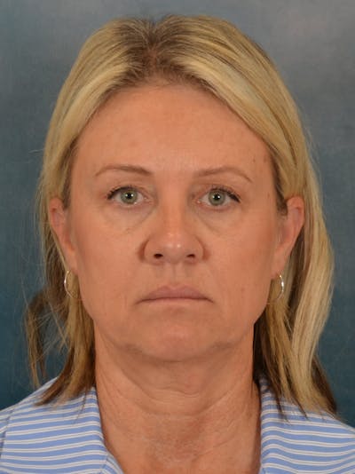 Brow Lift Before & After Gallery - Patient 199920 - Image 1