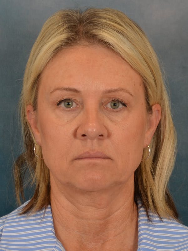 Fat Transfer Before & After Gallery - Patient 388623 - Image 1