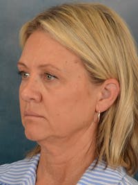 Deep Plane Facelift Before & After Gallery - Patient 148969 - Image 1