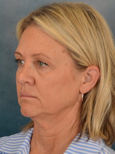 Deep Plane Facelift Before & After Gallery - Patient 414148 - Image 1