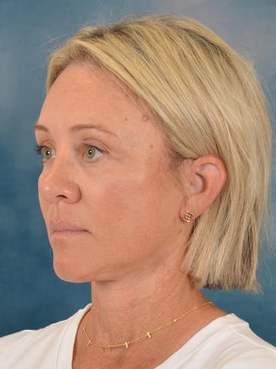 Fat Transfer Before & After Gallery - Patient 388623 - Image 4