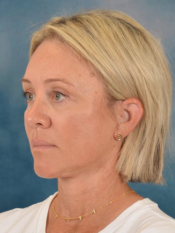Fat Transfer Before & After Gallery - Patient 388623 - Image 4