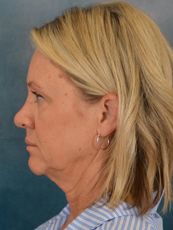 Fat Transfer Before & After Gallery - Patient 388623 - Image 5