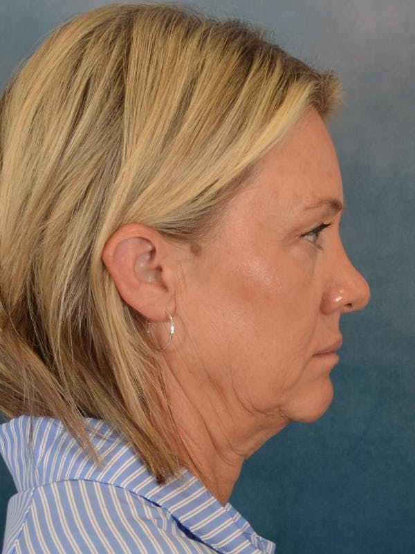 Fat Transfer Before & After Gallery - Patient 388623 - Image 9