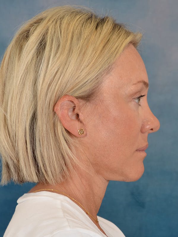 Fat Transfer Before & After Gallery - Patient 388623 - Image 10