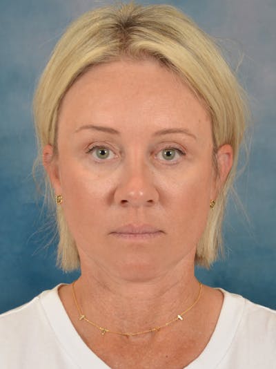 Fat Transfer Before & After Gallery - Patient 388623 - Image 2