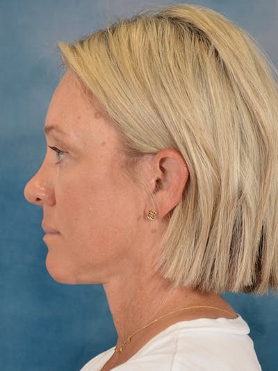 Fat Transfer Before & After Gallery - Patient 388623 - Image 6