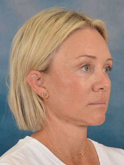 Fat Transfer Before & After Gallery - Patient 388623 - Image 8