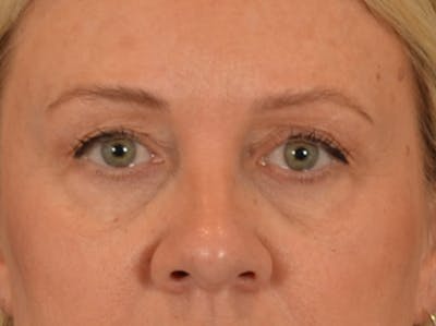 Eyelid Lift Before & After Gallery - Patient 340903 - Image 1