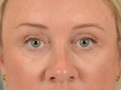 Eyelid Lift Before & After Gallery - Patient 340903 - Image 2