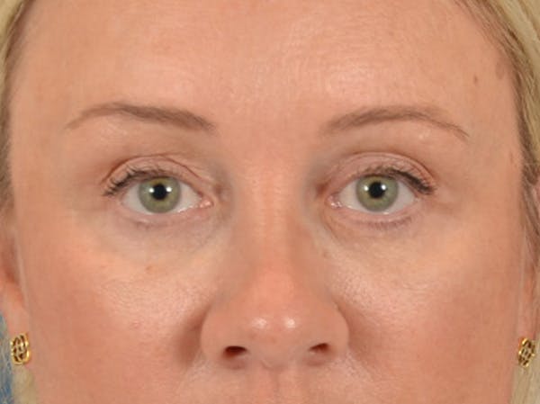 Eyelid Lift Before & After Gallery - Patient 340903 - Image 2