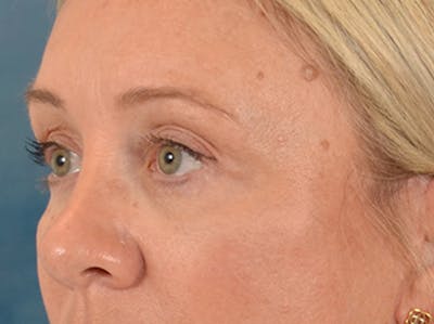 Eyelid Lift Before & After Gallery - Patient 340903 - Image 8